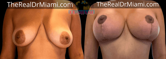 Before-and-after views for Breast Lift, Case 21.