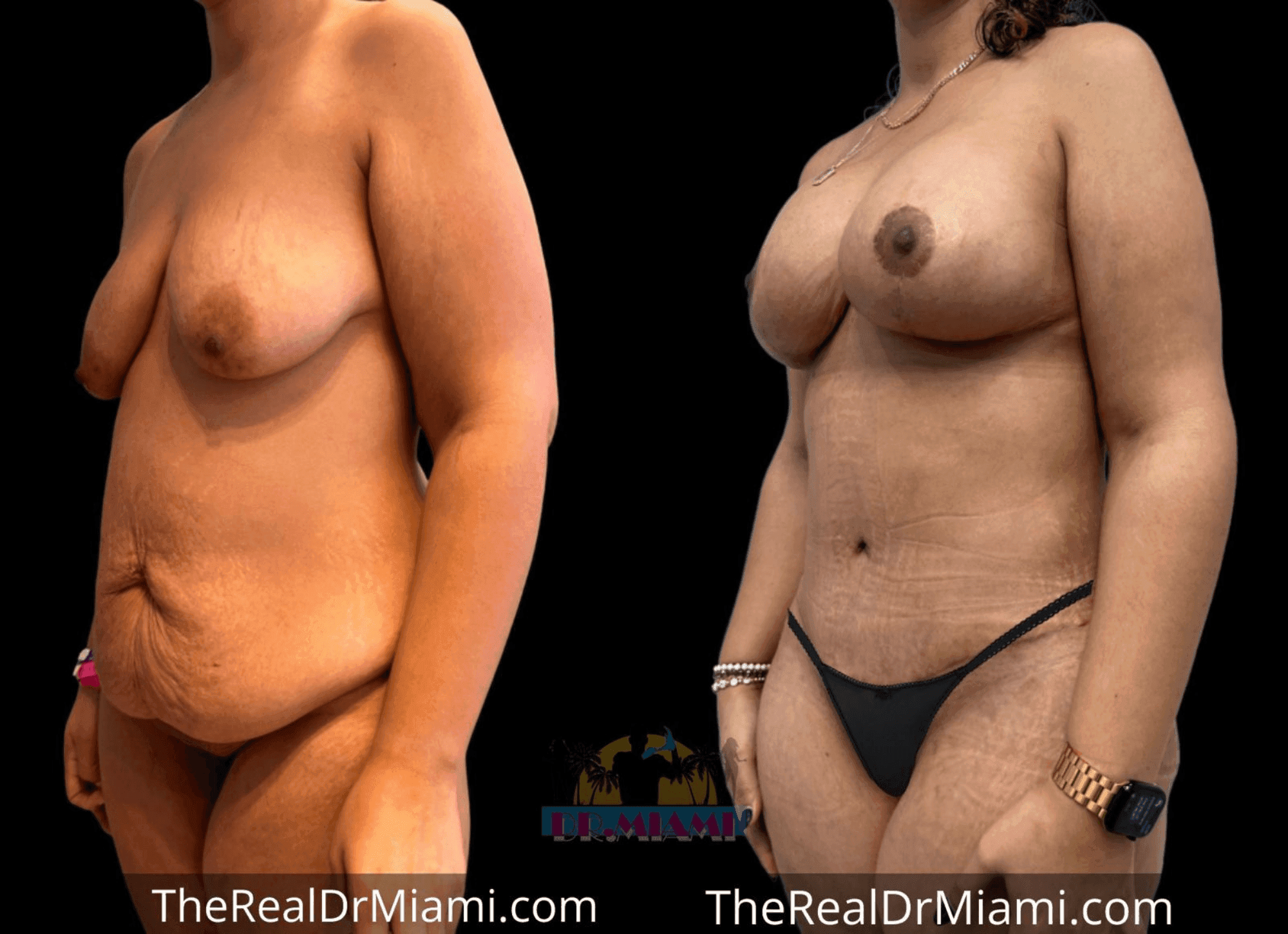 Before-and-after views for Mommy Makeover, Case 56.