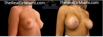 Before-and-after views for Breast Augmentation, Case 5.