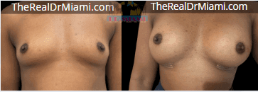 Before-and-after views for Breast Augmentation, Case 61.