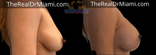 Before-and-after views for Breast Lift, Case 88.