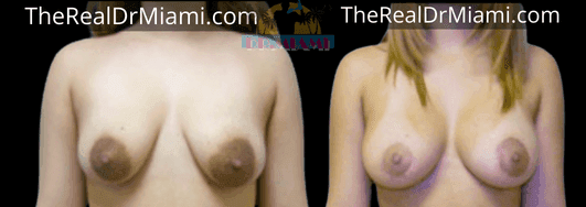 Before-and-after views for Breast Lift, Case 31.