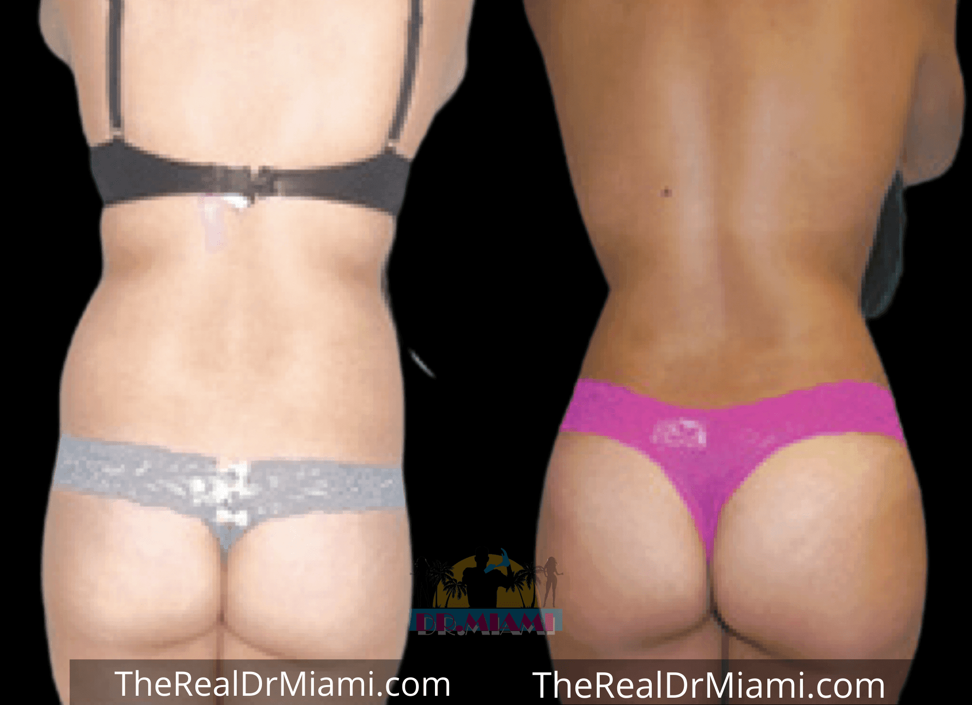 Before-and-after views for Brazilian Butt Lift, Case 83.