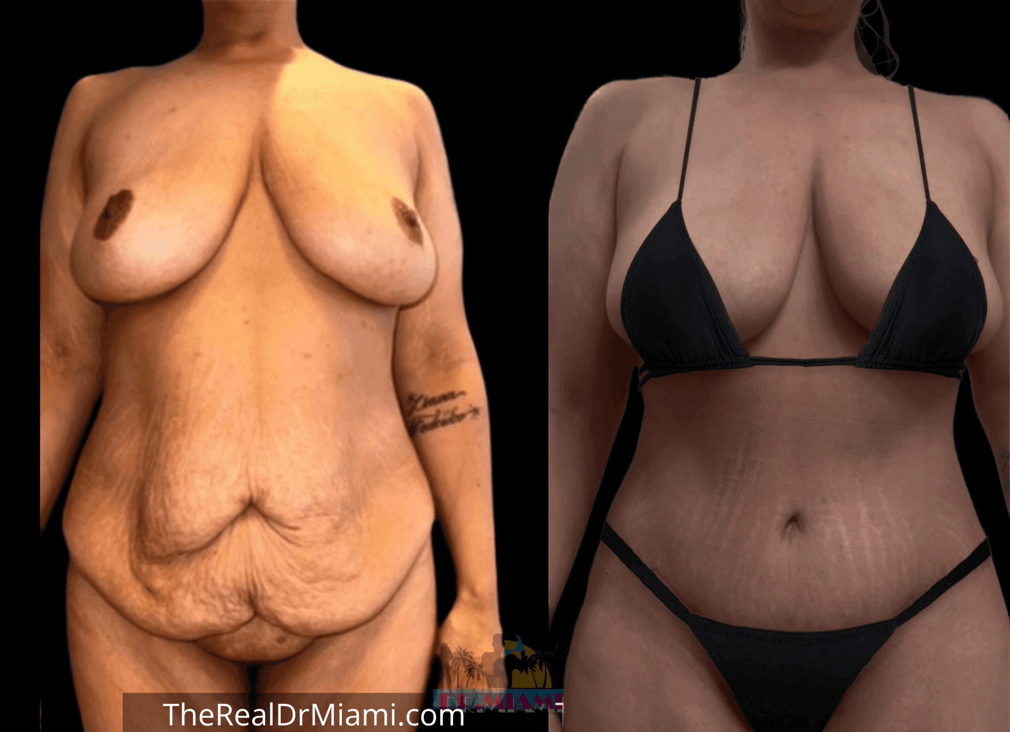 Before-and-after views for Tummy Tuck, Case 67.