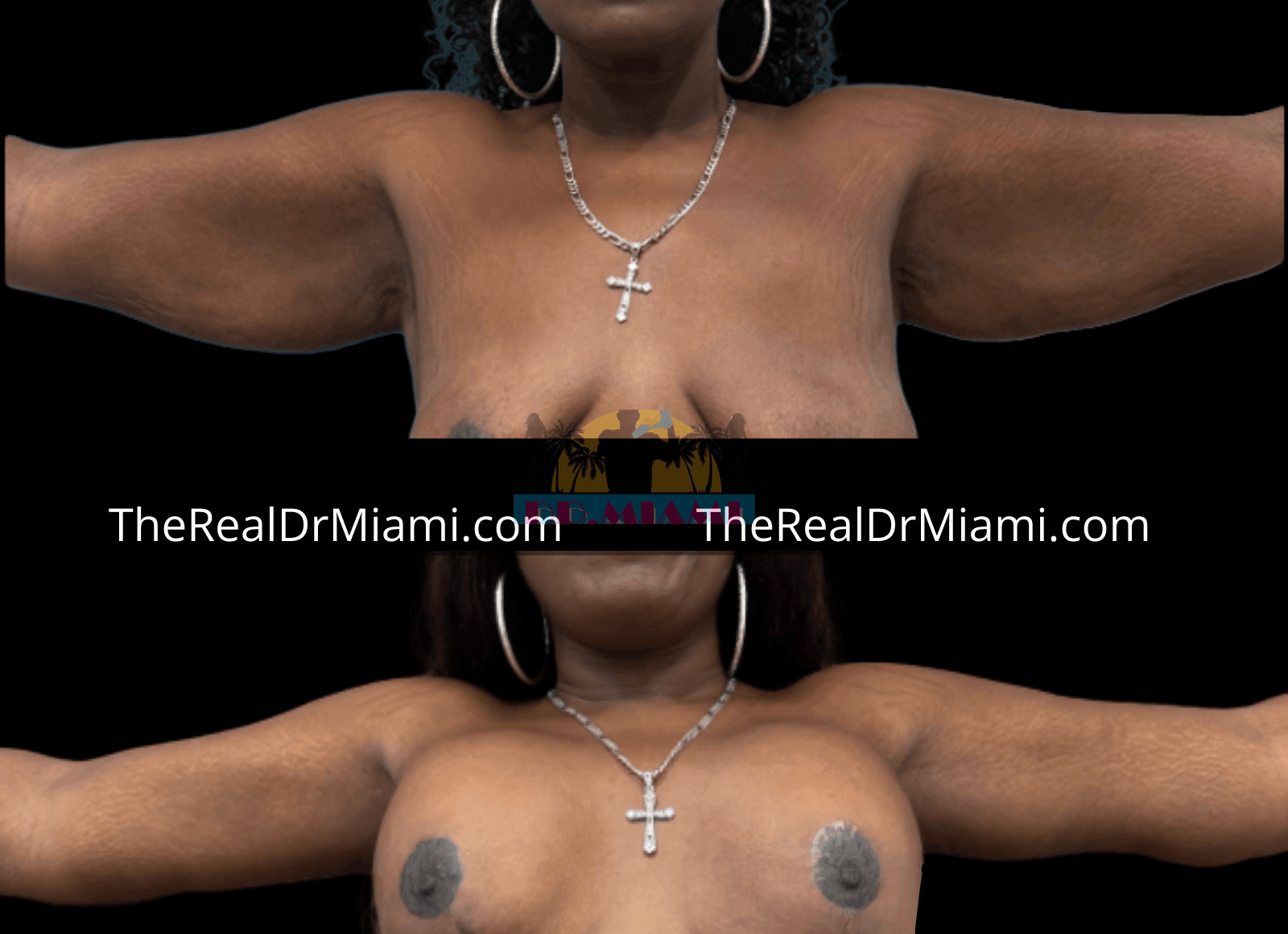 Before-and-after views for Upper Arm Lift, Case 9.