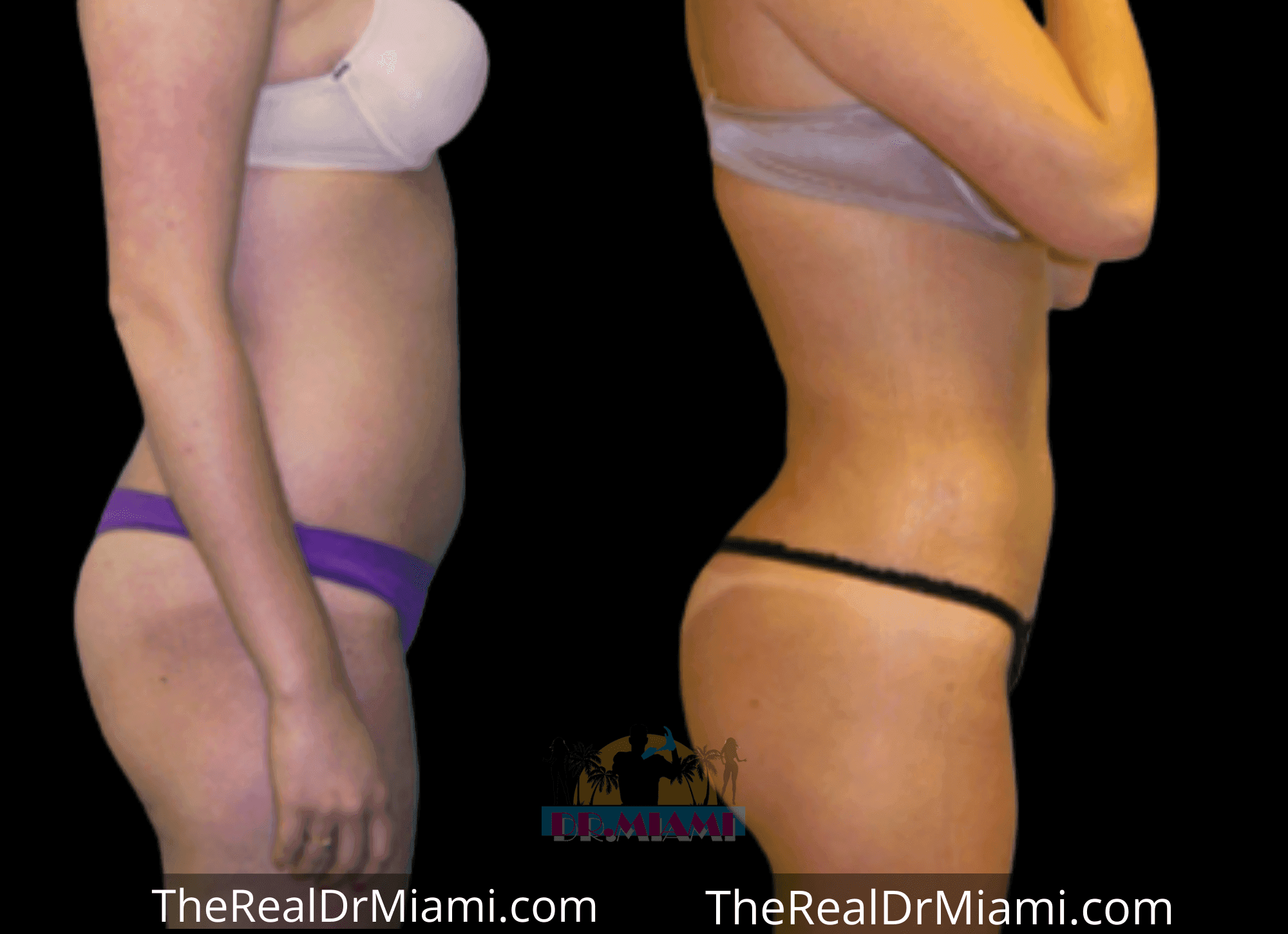Before-and-after views for Brazilian Butt Lift, Case 60.