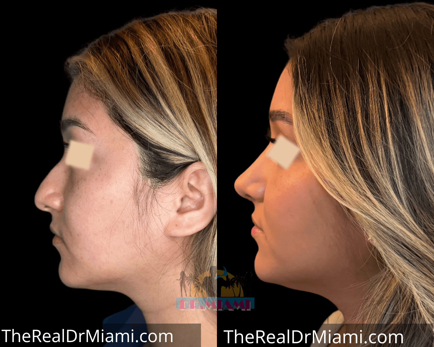 Before-and-after views for Rhinoplasty, Case 9.