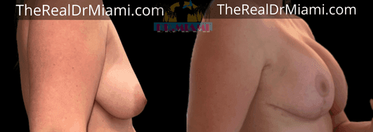 Before-and-after views for Breast Lift, Case 86.