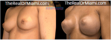 Before-and-after views for Breast Augmentation, Case 60.