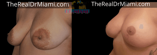 Before-and-after views for Breast Lift, Case 100.