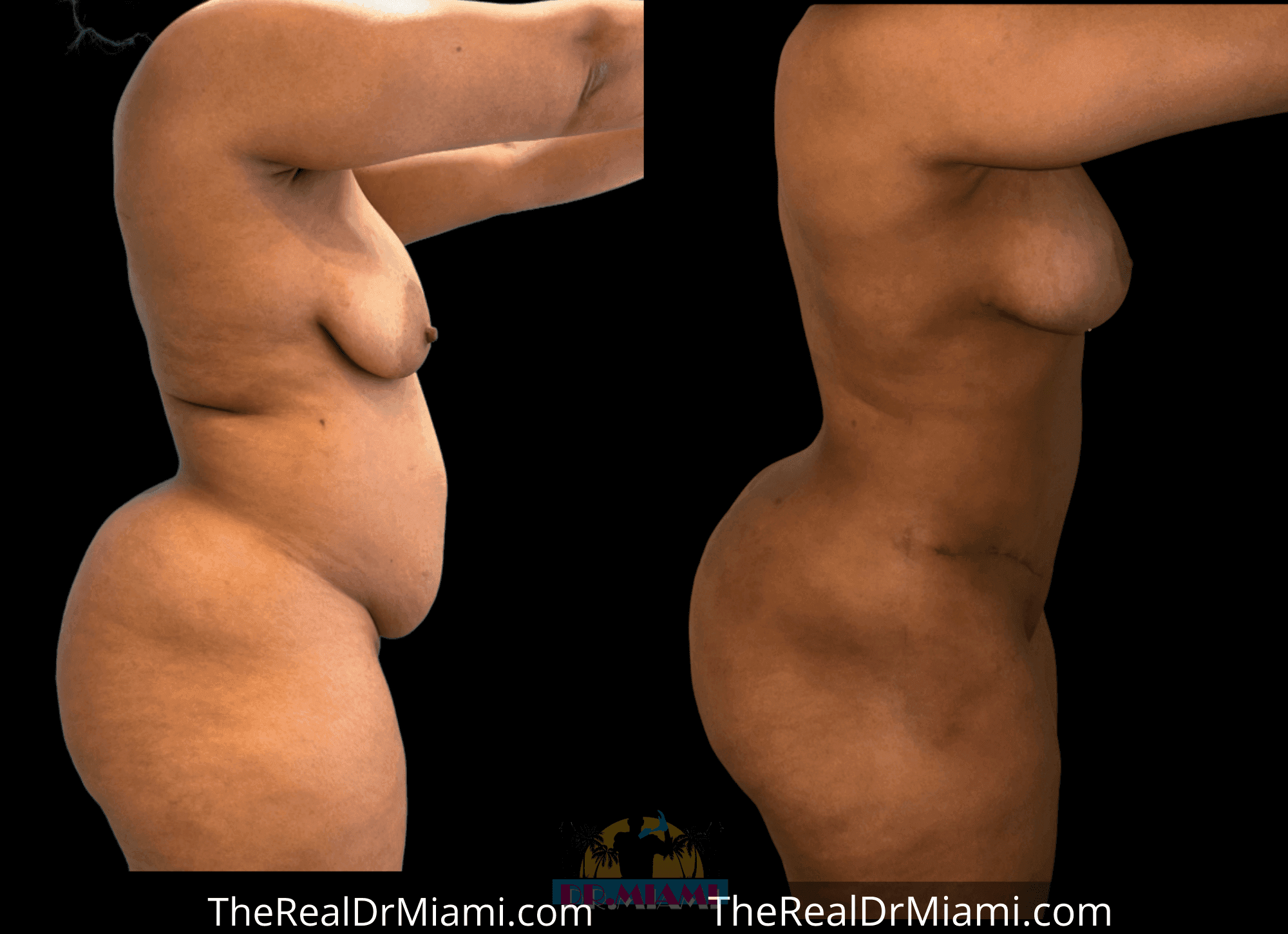Before-and-after views for Mommy Makeover, Case 120.