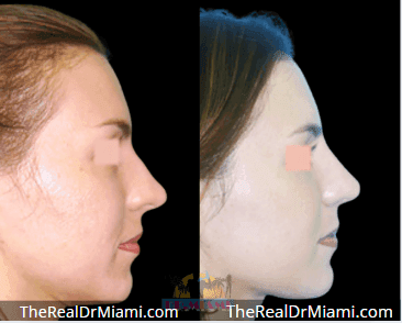 Before-and-after views for Rhinoplasty, Case 88.