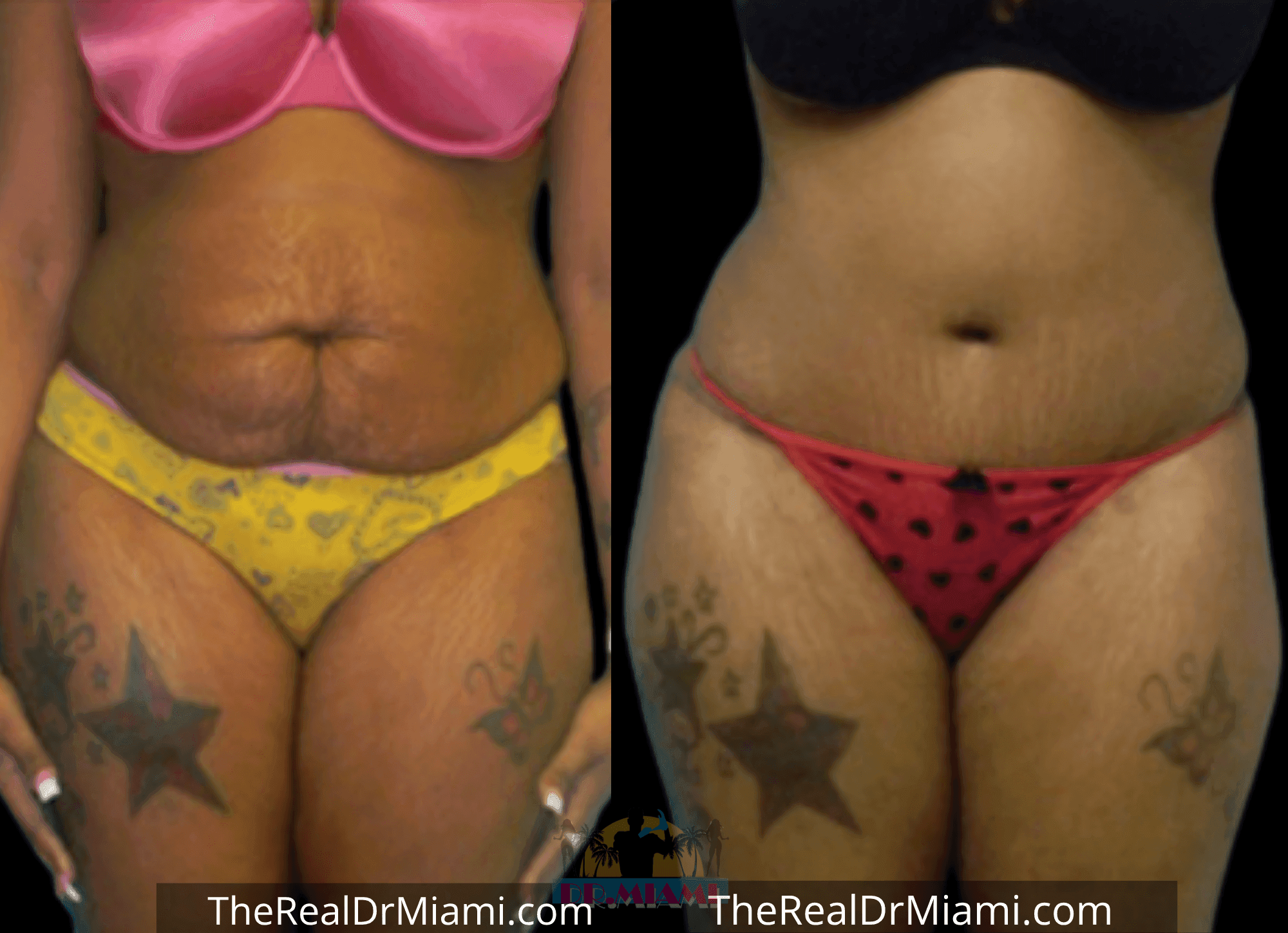 Before-and-after views for Tummy Tuck, Case 63.