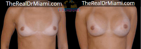 Before-and-after views for Breast Augmentation, Case 123.