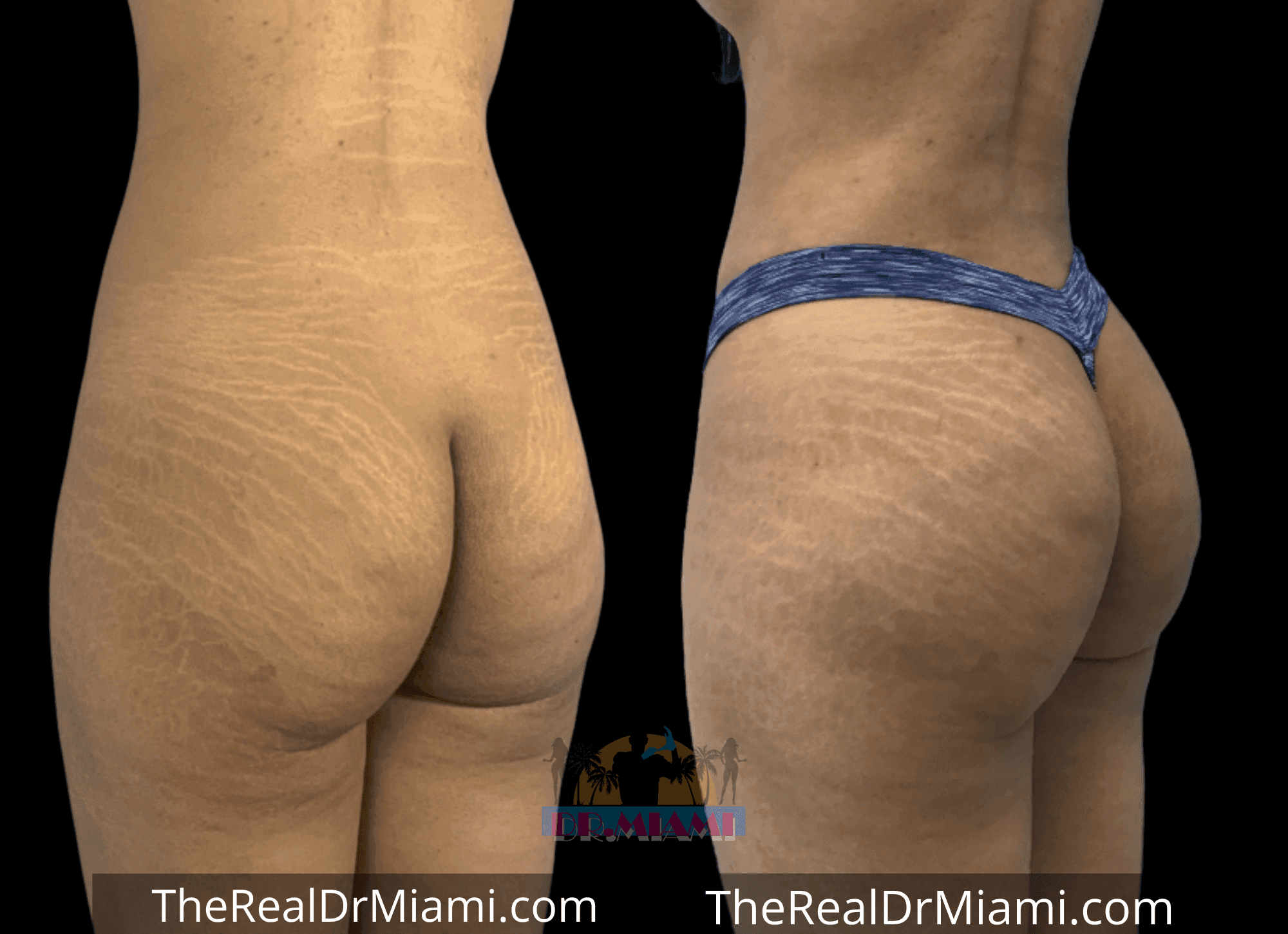 Before-and-after views for Brazilian Butt Lift, Case 27.