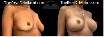 Before-and-after views for Breast Augmentation, Case 7.