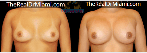 Before-and-after views for Breast Augmentation, Case 95.