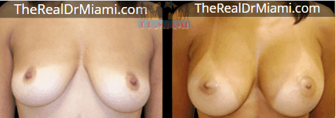 Before-and-after views for Breast Augmentation, Case 106.