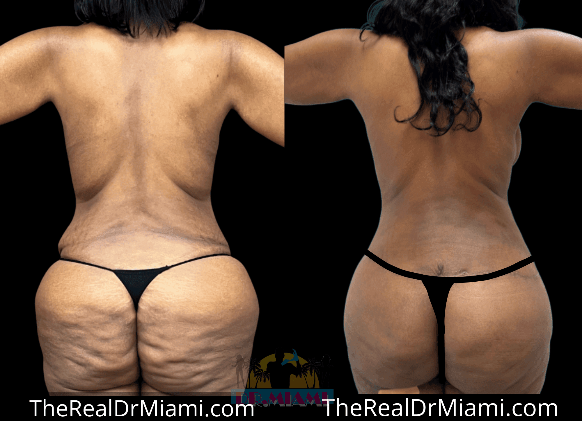 Before-and-after views for Massive Weight Loss, Case 39.