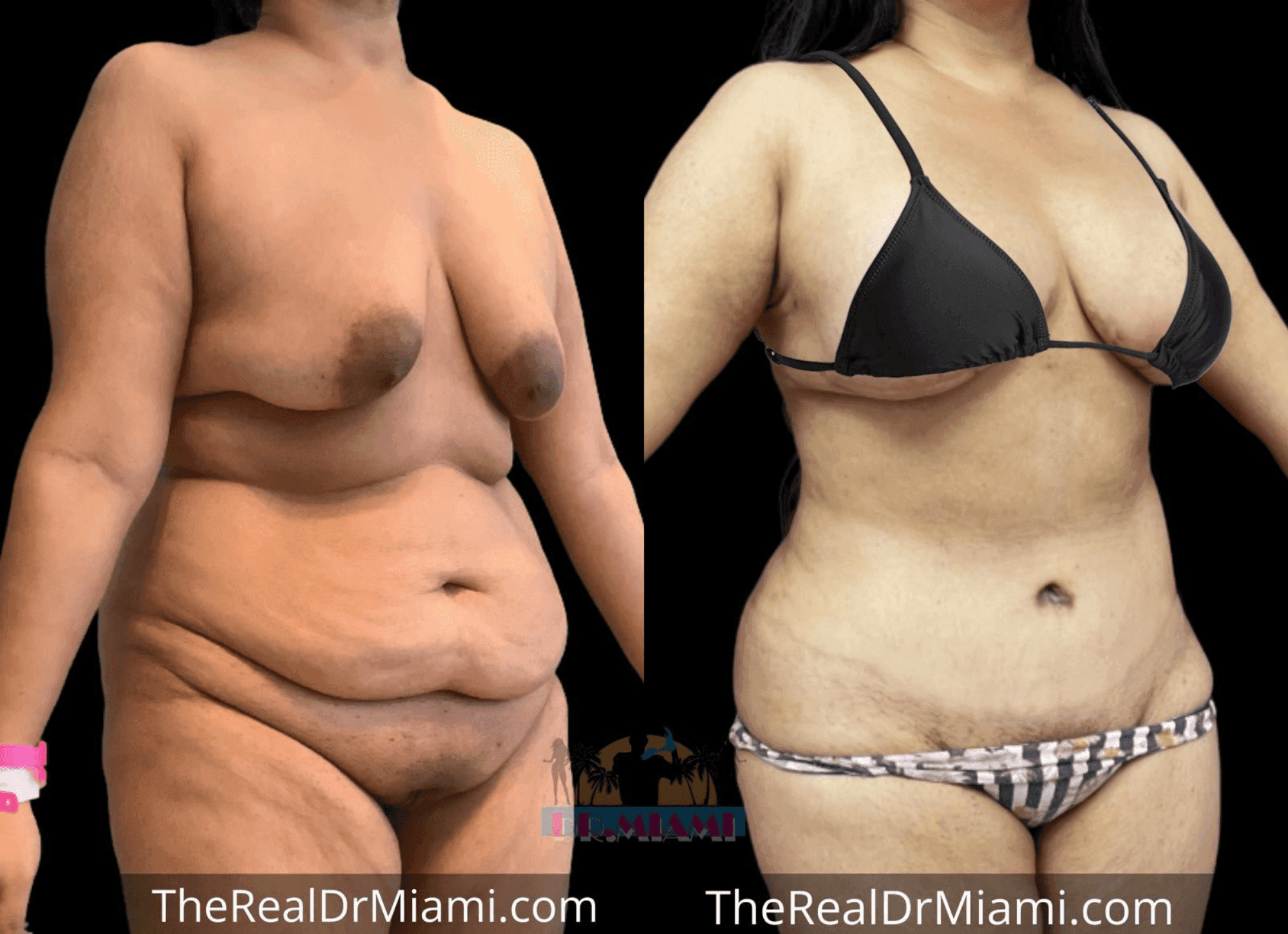Before-and-after views for Mommy Makeover, Case 52.