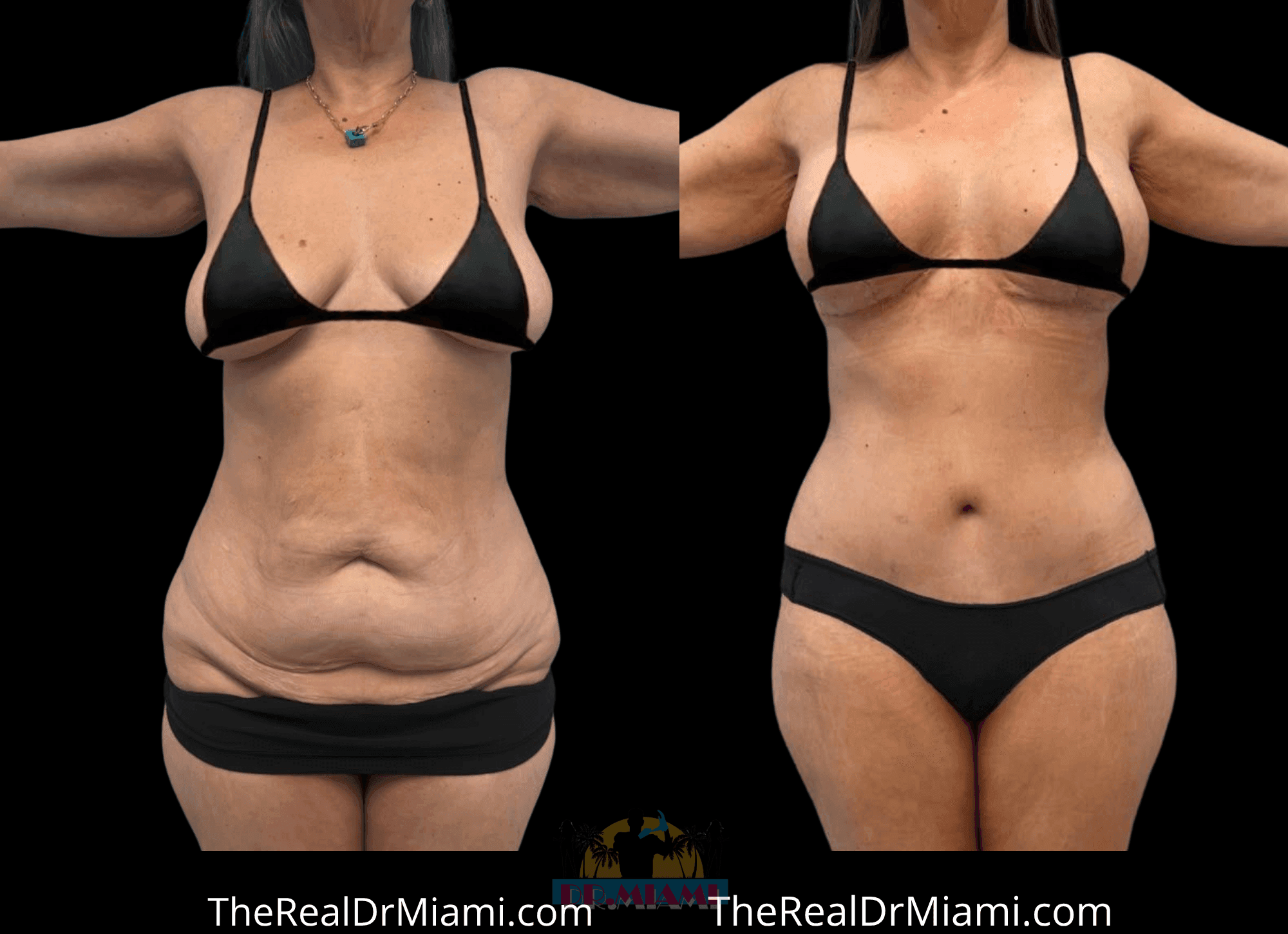 Before-and-after views for Mommy Makeover, Case 127 — Additional result.