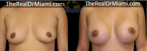 Before-and-after views for Breast Augmentation, Case 109.
