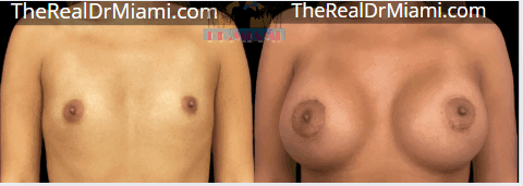 Before-and-after views for Breast Augmentation, Case 126.