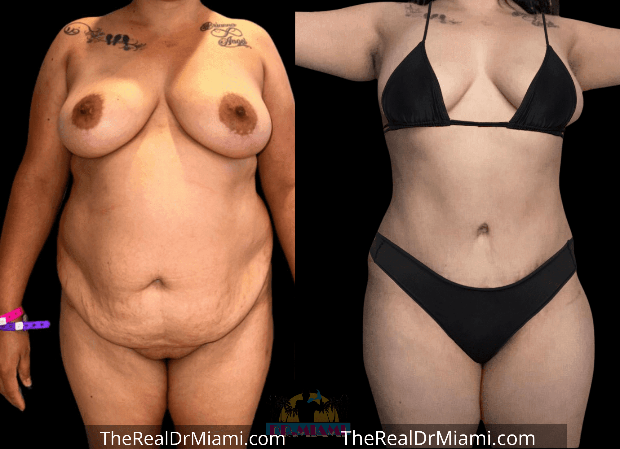 Before-and-after views for Tummy Tuck, Case 53.