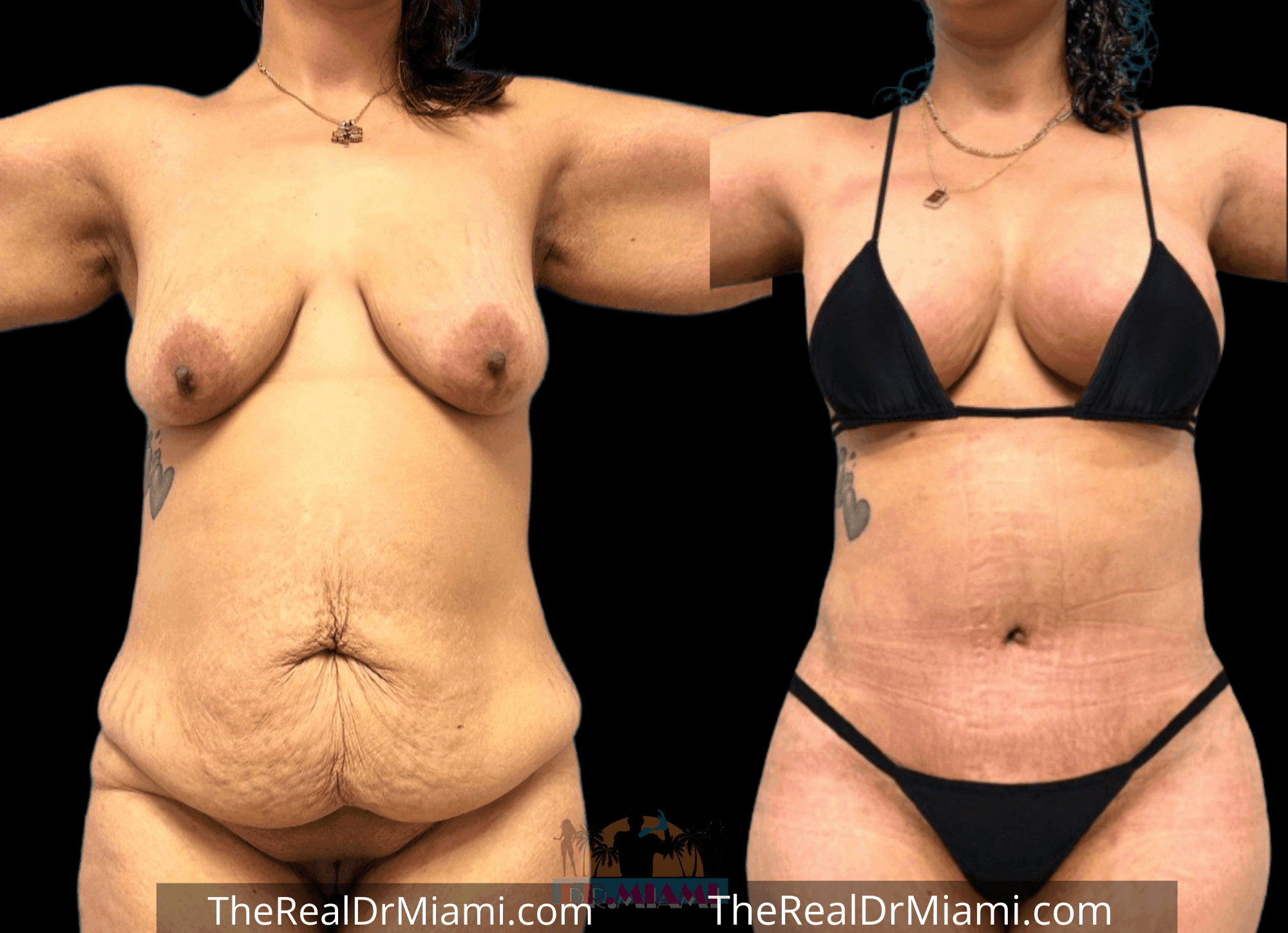 Before-and-after views for Mommy Makeover, Case 81.