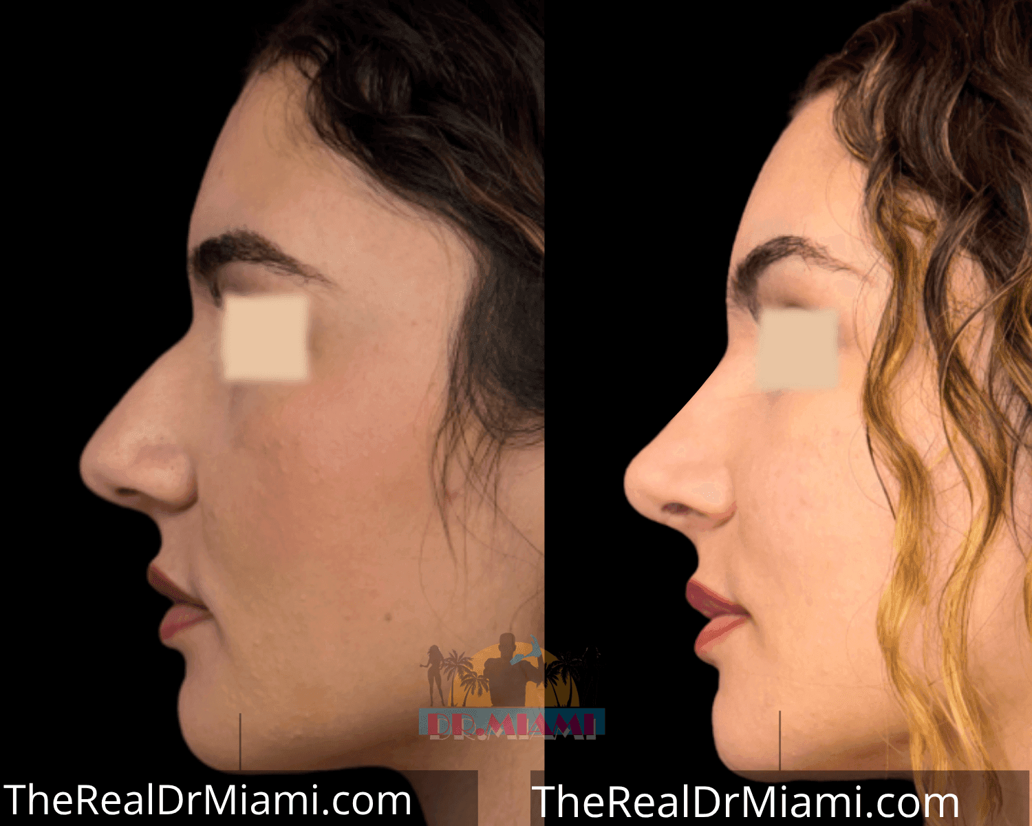 Before-and-after views for Rhinoplasty, Case 26.