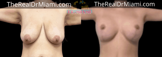 Before-and-after views for Breast Lift, Case 53.