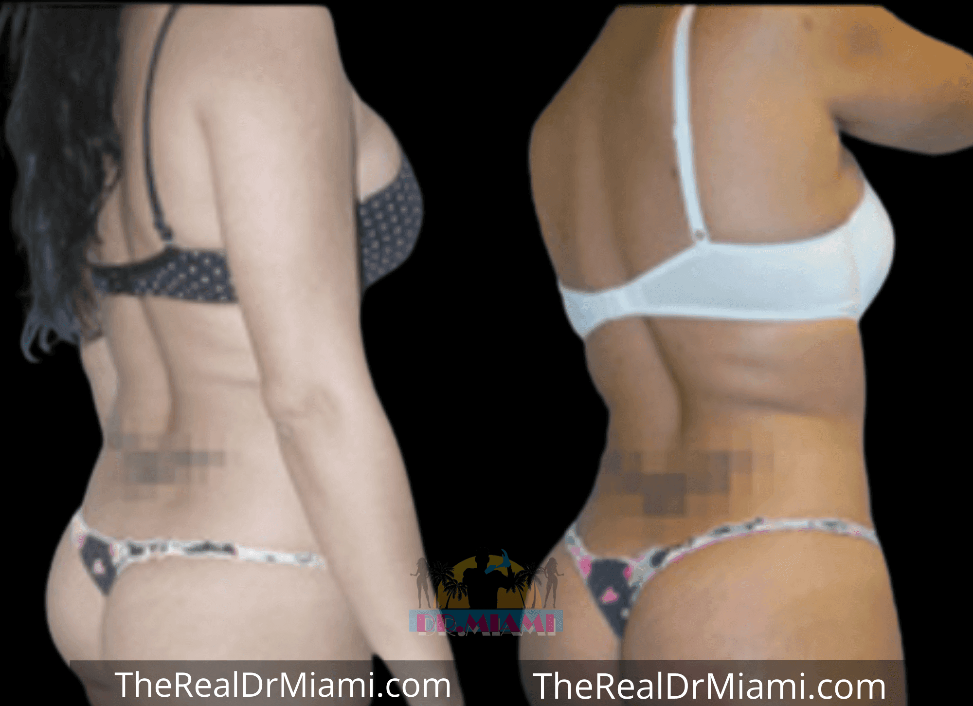 Before-and-after views for Brazilian Butt Lift, Case 40.