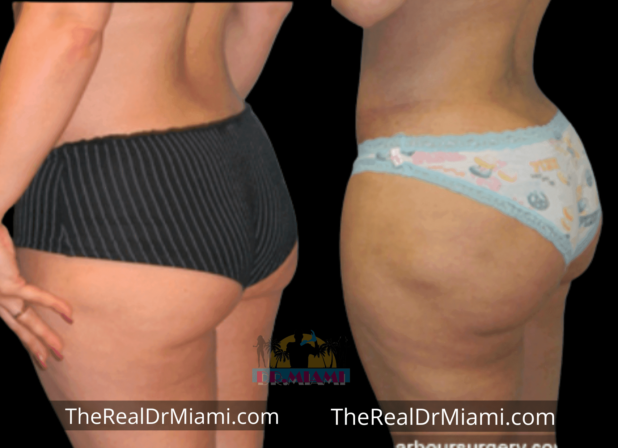 Before-and-after views for Brazilian Butt Lift, Case 62.