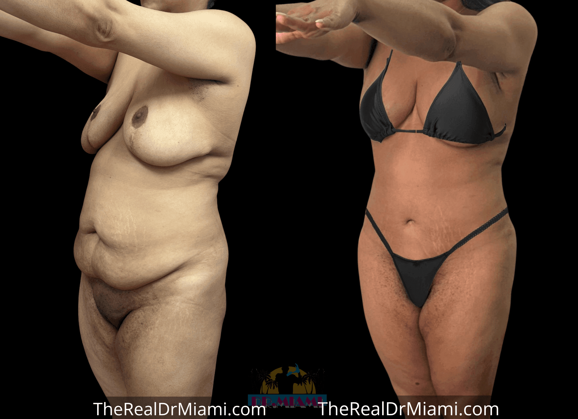 Before-and-after views for Mommy Makeover, Case 103.