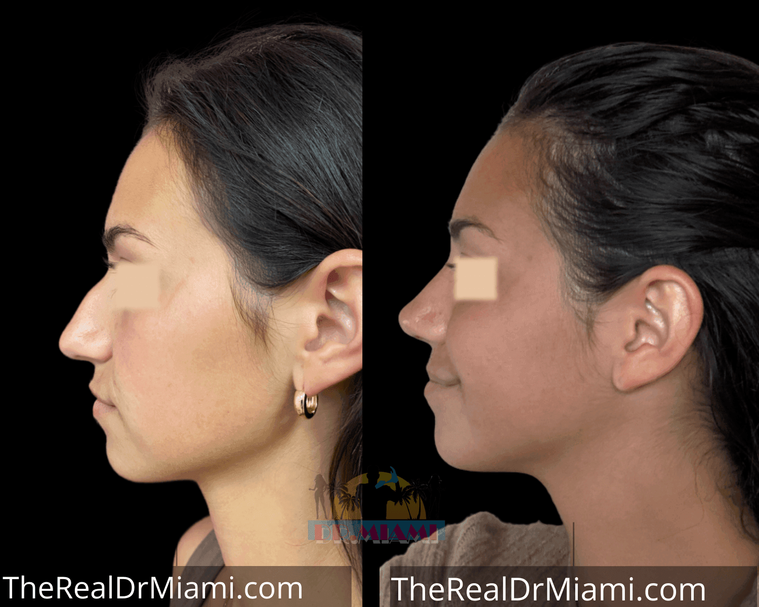 Before-and-after views for Rhinoplasty, Case 52.