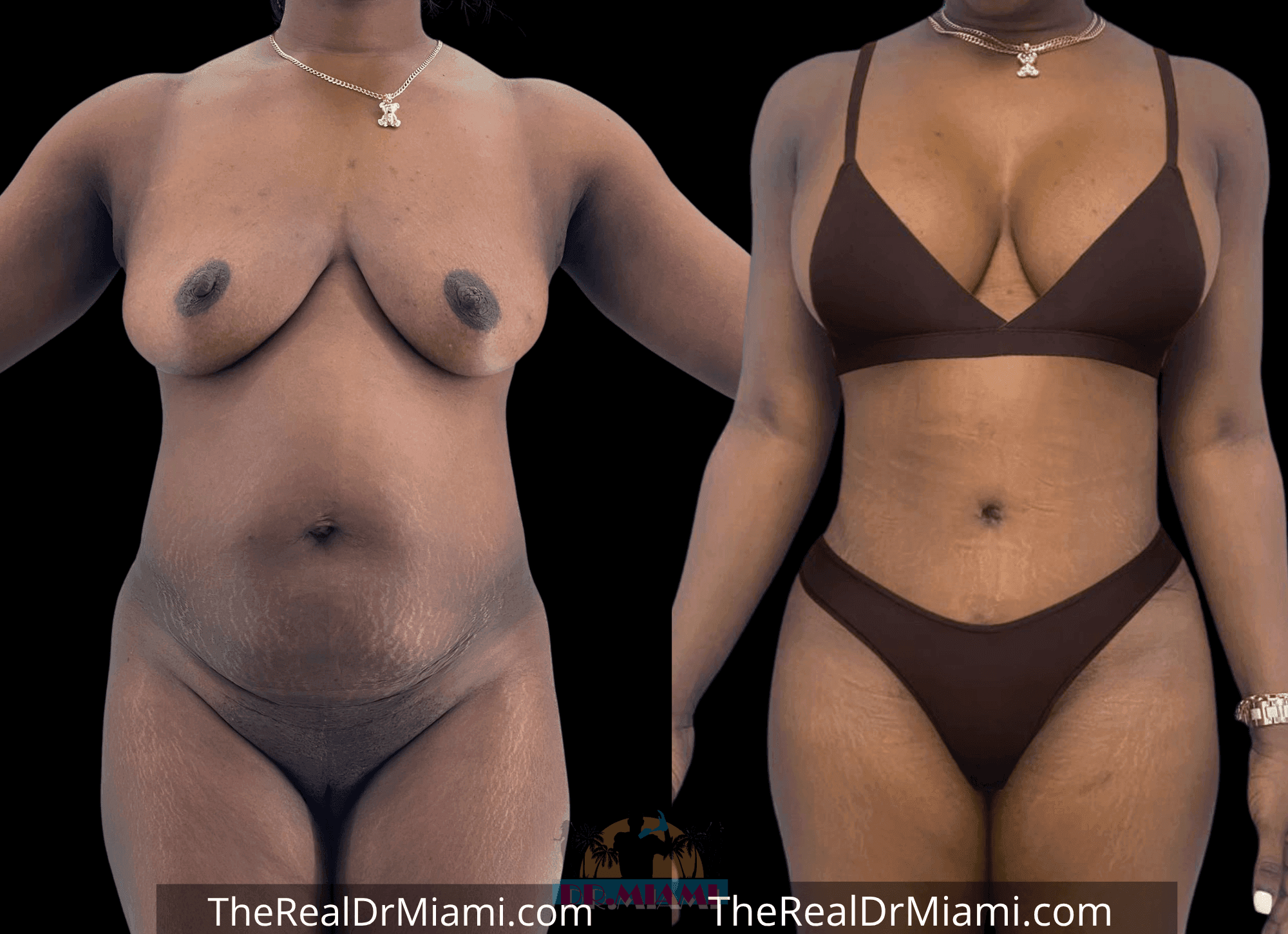 Before-and-after views for Tummy Tuck, Case 103.