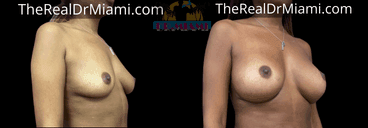 Before-and-after views for Breast Augmentation, Case 86.