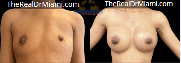 Before-and-after views for Breast Augmentation, Case 11.