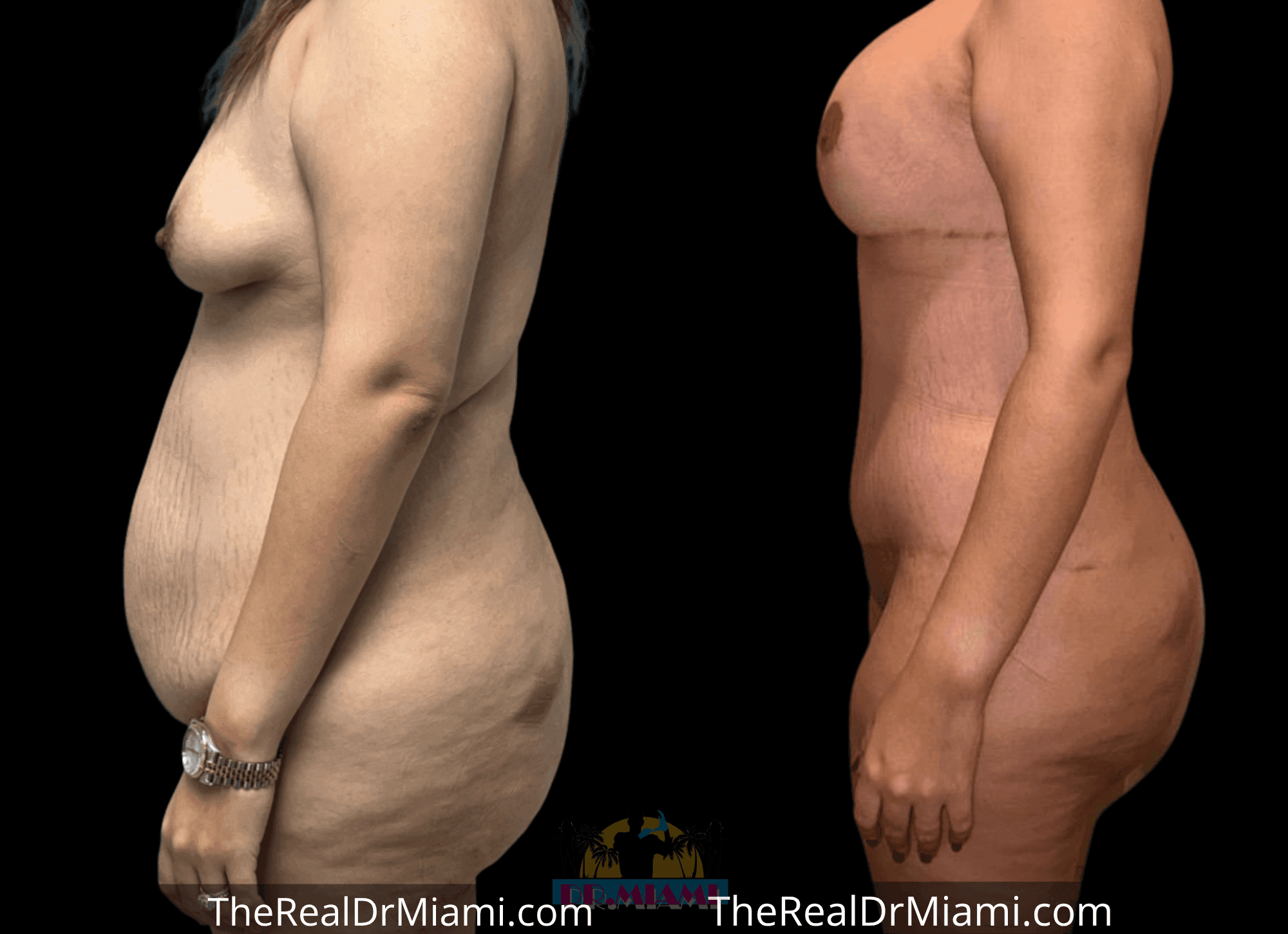 Before-and-after views for Tummy Tuck, Case 105.