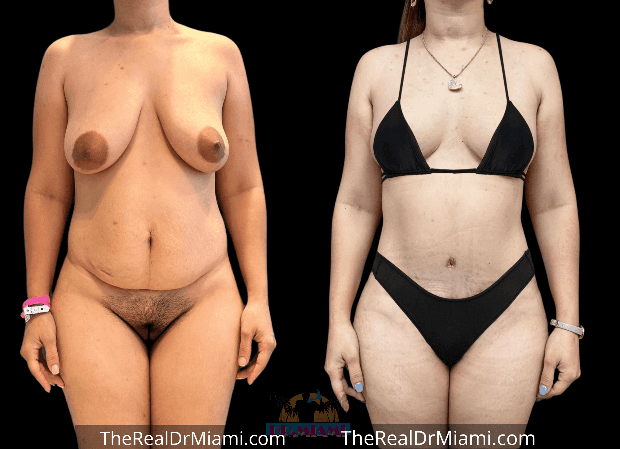 Before-and-after views for Mommy Makeover, Case 101.