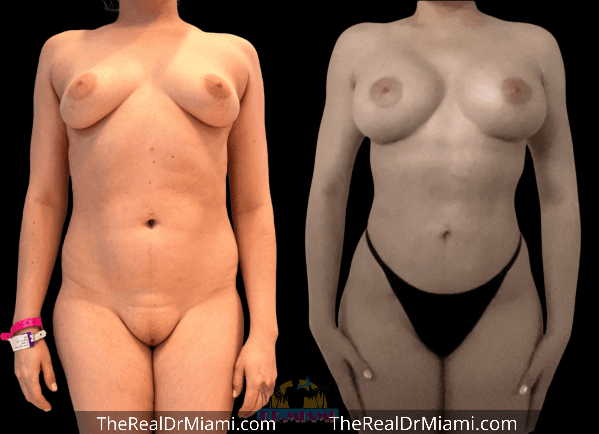 Before-and-after views for Mommy Makeover, Case 110.