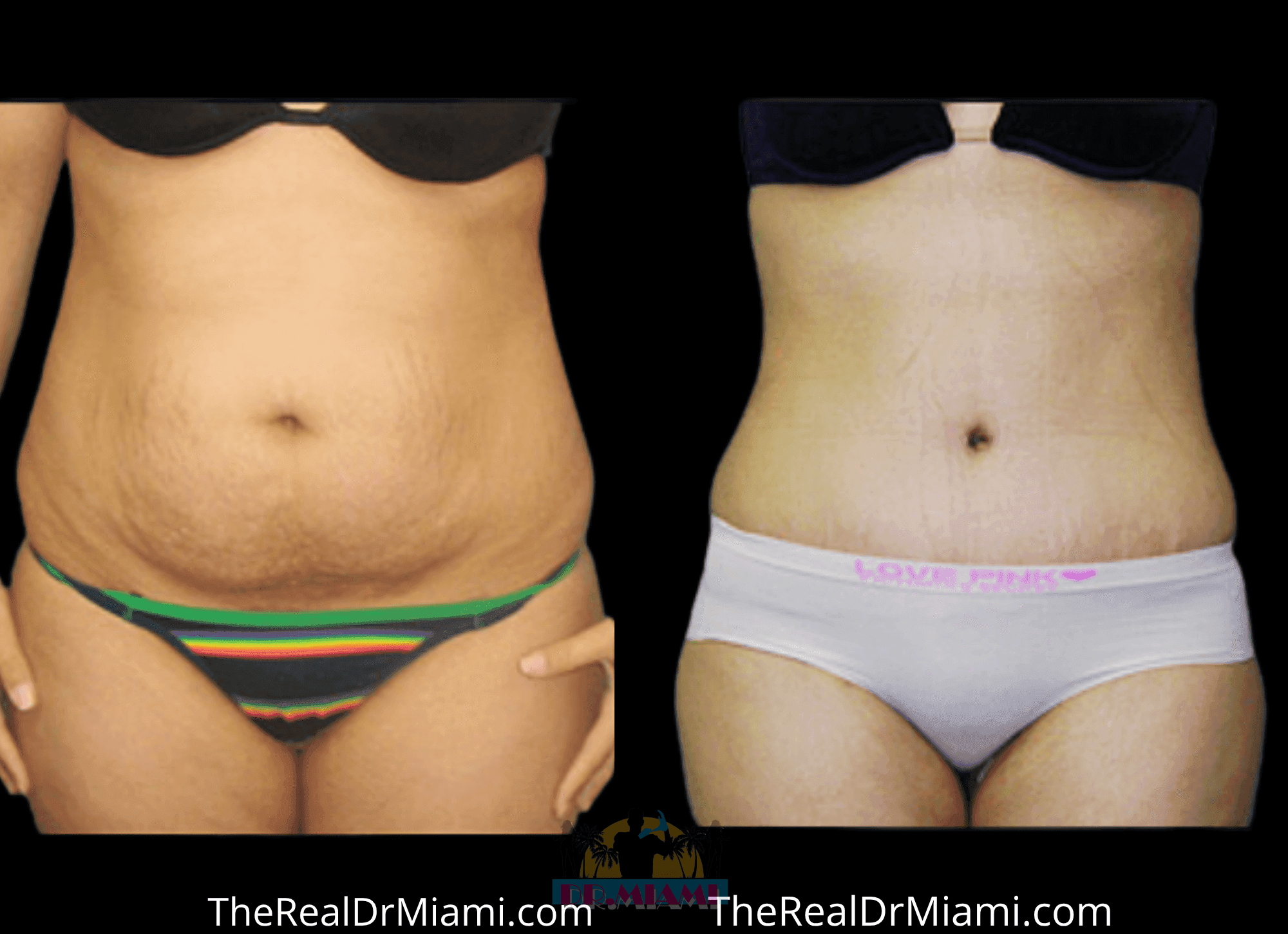 Before-and-after views for Tummy Tuck, Case 93.