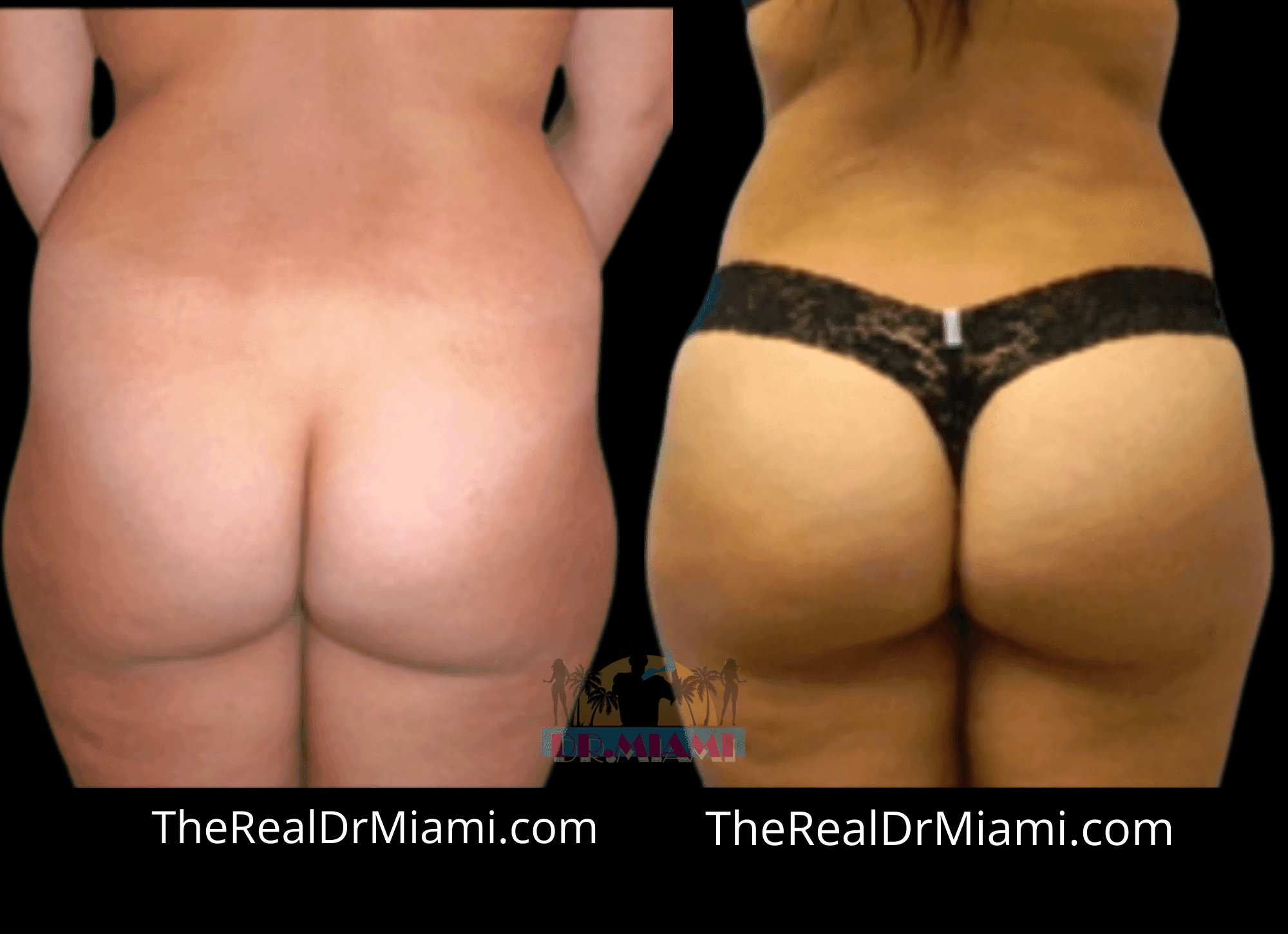 Before-and-after views for Brazilian Butt Lift, Case 103.