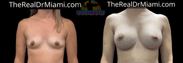 Before-and-after views for Breast Augmentation, Case 89.