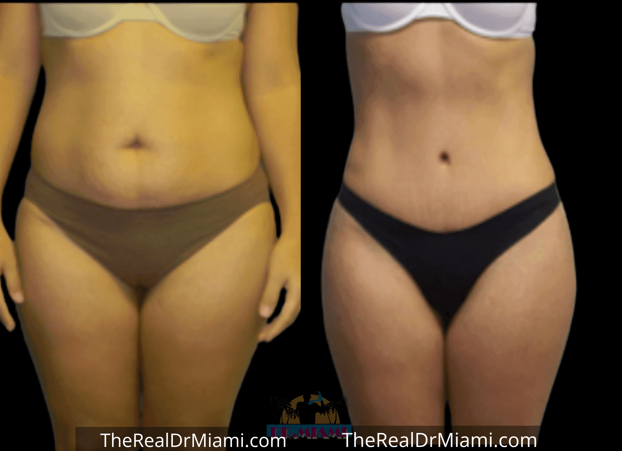 Before-and-after views for Tummy Tuck, Case 69.