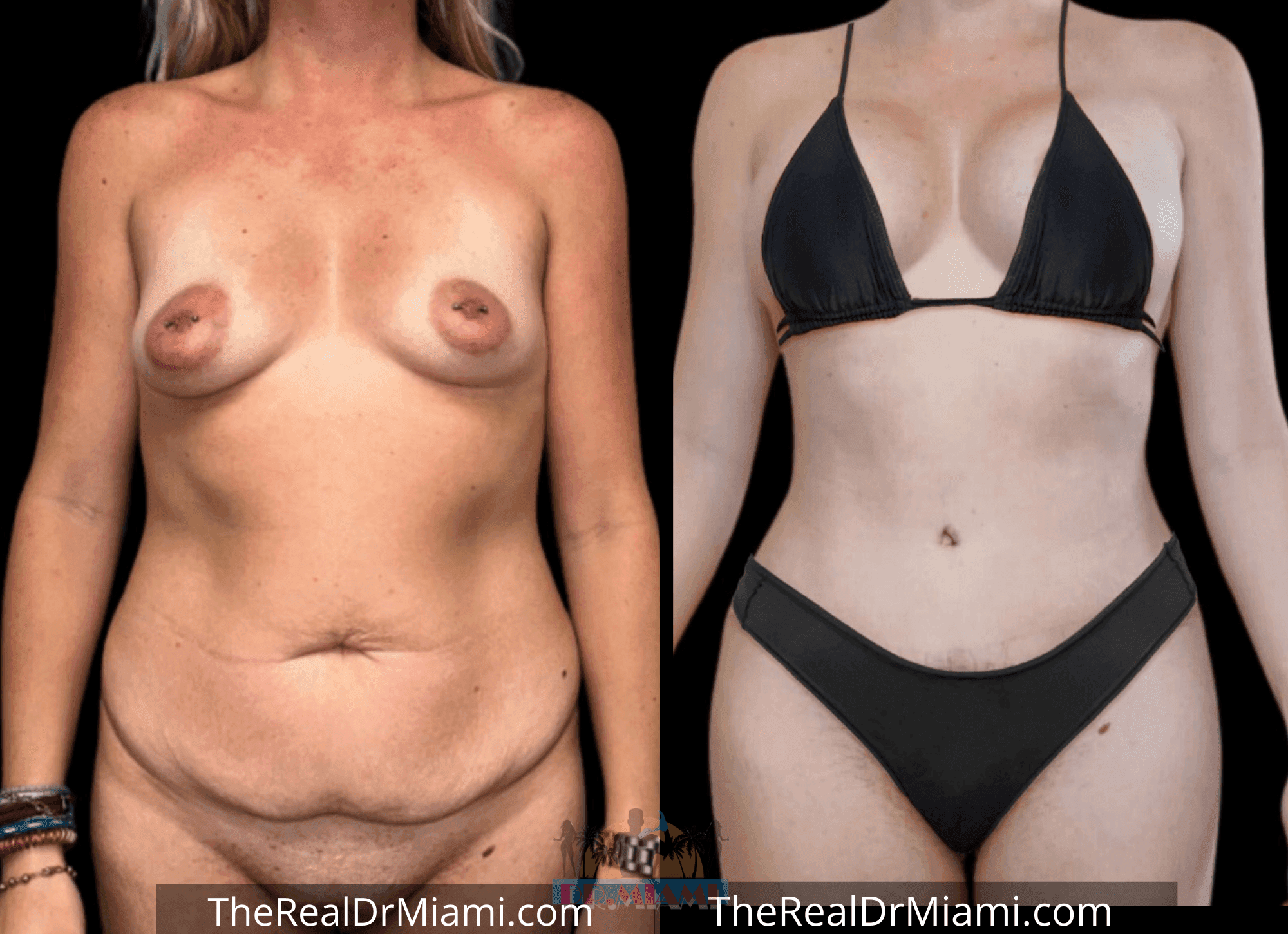 Before-and-after views for Mommy Makeover, Case 96.