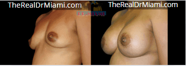 Before-and-after views for Breast Augmentation, Case 26.