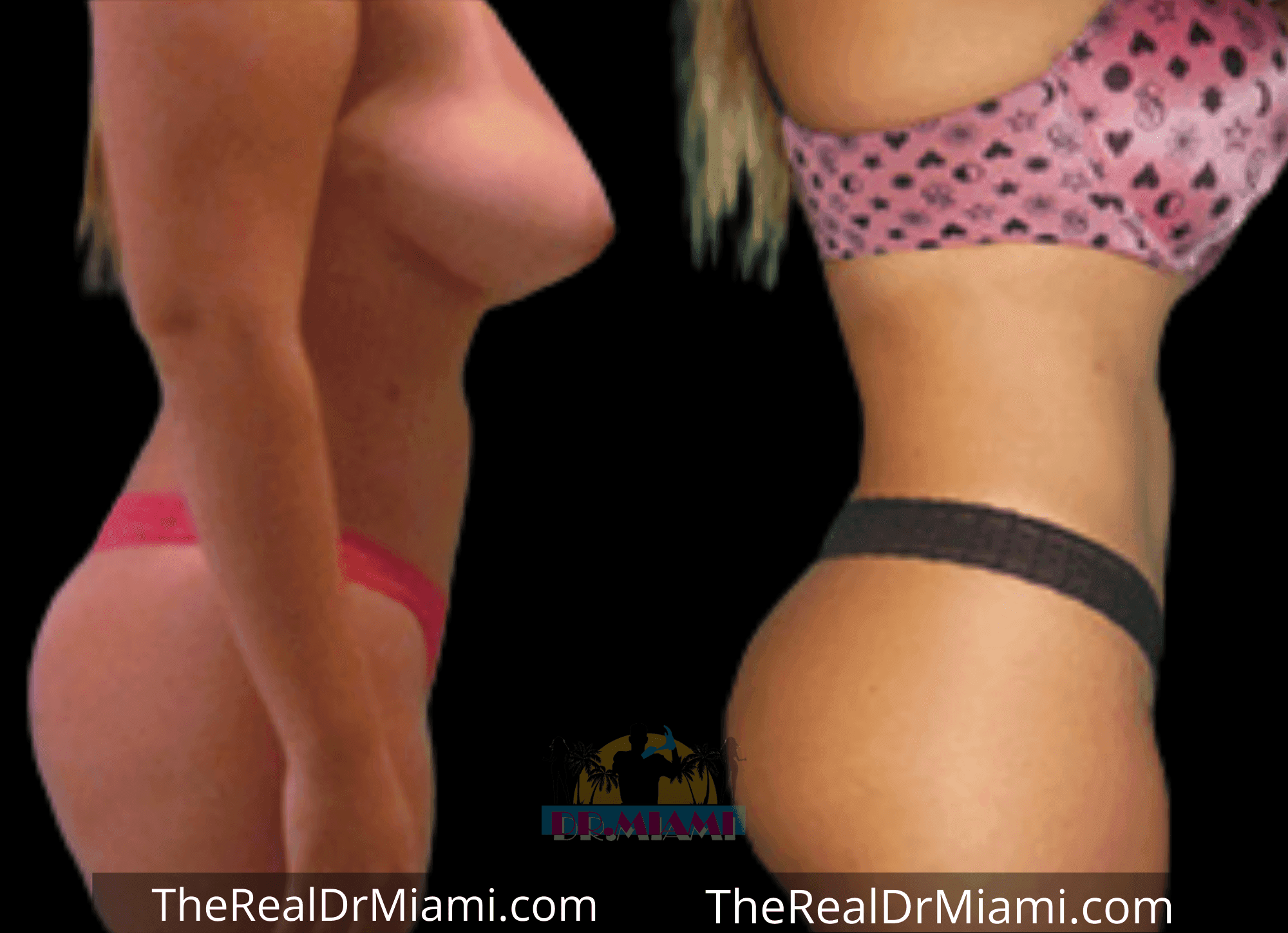 Before-and-after views for Brazilian Butt Lift, Case 94.
