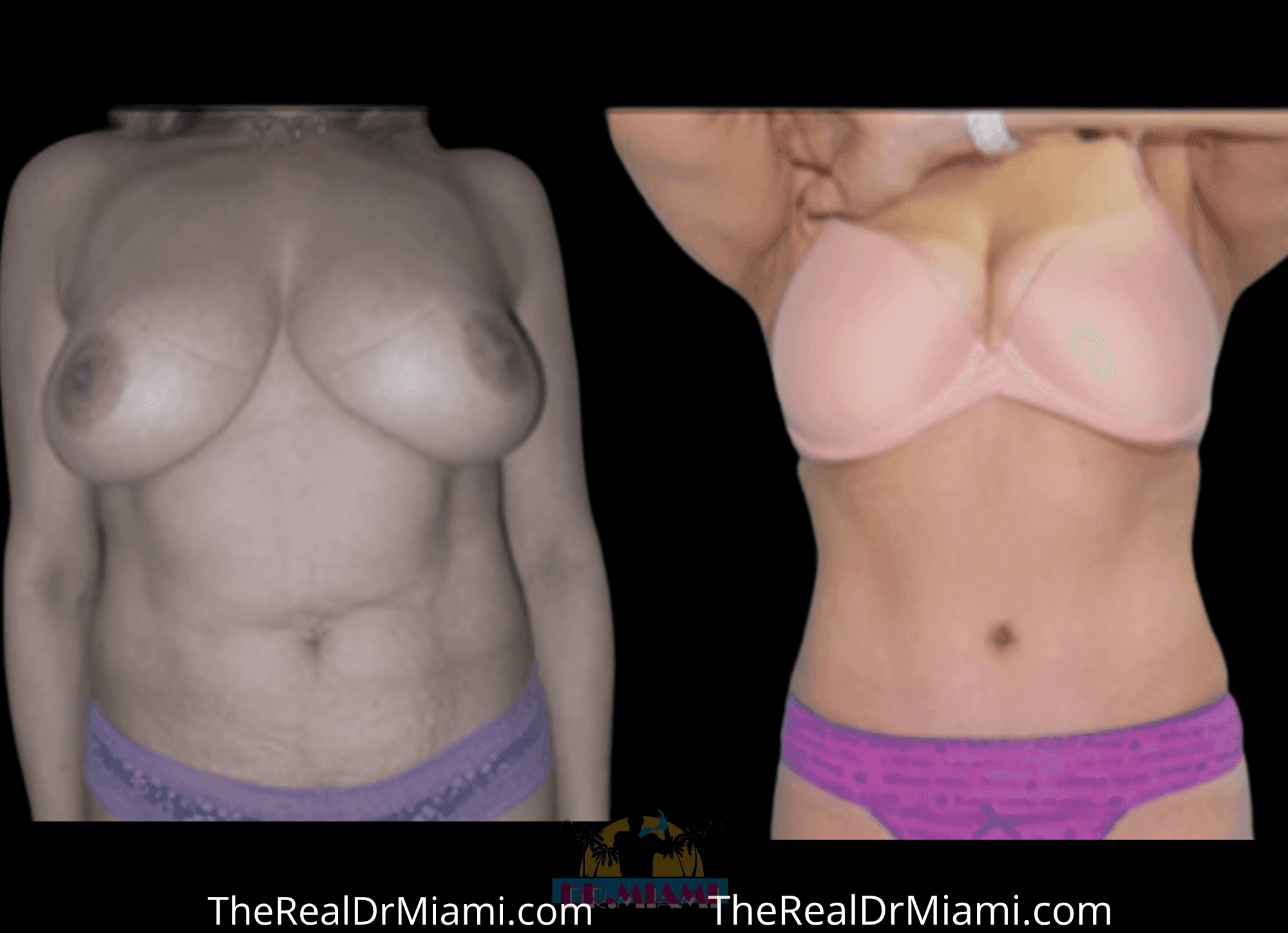 Before-and-after views for Tummy Tuck, Case 88.
