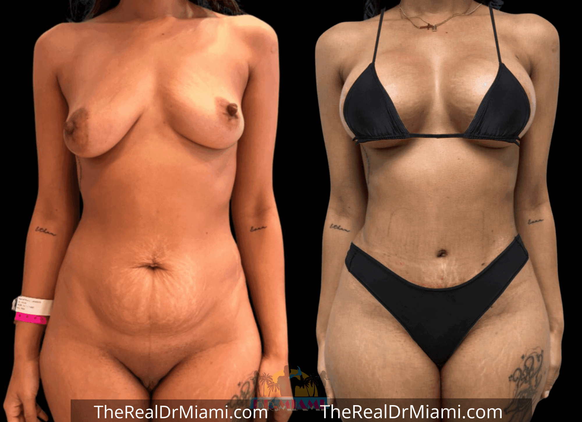 Before-and-after views for Tummy Tuck, Case 104.